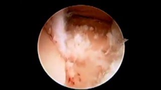 Subtalar Joint Arthroscopy Debridement SFISM [upl. by Ulrike690]