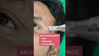 Microneedling Procedure at VCare  Best Treatment For Acne Acne Scars Wrinkles amp Fine Lines [upl. by Kwang465]