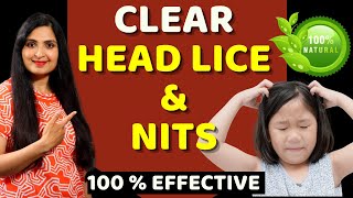 HOW TO REMOVE HEAD LICE amp NITS  Treat Lice Without Chemicals  Natural Remedy Headlice Haircare [upl. by Ahsenak]