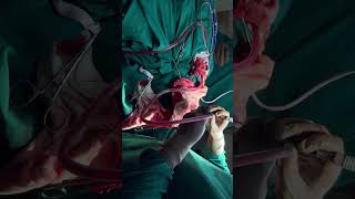 craniotomy surgeryshort video virallike share Subscribe amp follow 👍 [upl. by Walsh]