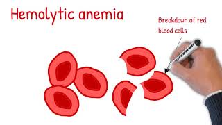 Hemolytic anemia made easy Intrinsic vs extrinsic hemolytic anemia [upl. by Kalin]