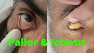 PALLOR and ICTERUS in EYE  ANEMIA and JAUNDICE in eye examination [upl. by Archaimbaud]