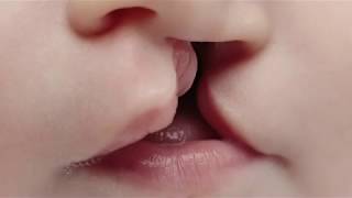 Cleft lip and palate  Akron Childrens Hospital video [upl. by Sarad335]