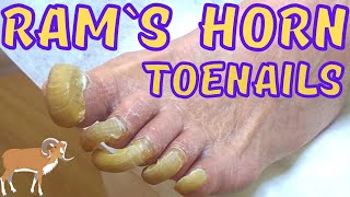 Rams horn Super long toenails painless trimming Onychogryphosis [upl. by Suzan]