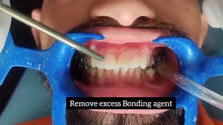 Orthodontic Bonding Procedure [upl. by Nnaeirelav931]