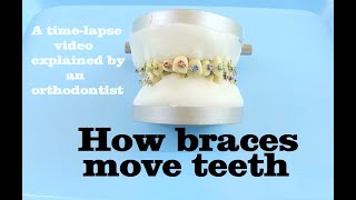 How braces move teeth timelapse  Braces Explained [upl. by Ettenoj34]