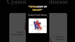 Tetralogy of fallot pediatrics heart child cyanosis blue baby mother kids medicine [upl. by Ennaeerb]