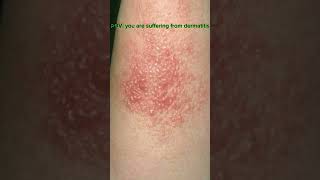 How I Manage My Dermatitis Tips for Soothing Irritated SkinDermatitisSkincareJourneySkinCareTips [upl. by Luis223]