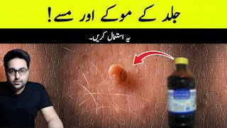 Dr ZeeUse Iodine for Skin Tags and Warts  डॉक्टर ज़ी [upl. by Rue]