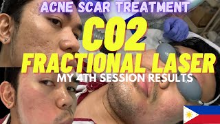 My 5th Session with Co2 Fractional Laser Treatment for my Acne Scars  Before and After Results [upl. by Navonod547]