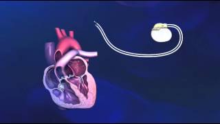 Implantatie van een tweekamerpacemaker  Medtronic [upl. by Britni735]