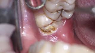 operculectomy of mn 3dr molar [upl. by Lenci545]