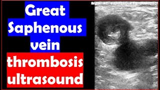 Great Saphenous vein thrombosis Ultrasound [upl. by Ynomrah728]