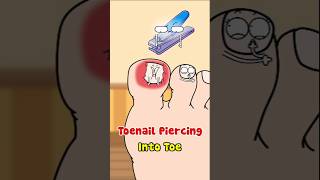 Toenail Piercing Into Toe [upl. by Feldman]