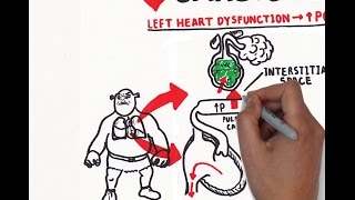 Pulmonary edema USMLE step 1 [upl. by Eiuqcaj371]