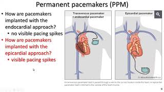 Permanent pacemakers and implantable cardiac defibrillators for exercise professionals the basics [upl. by Friedland]