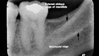 Dental Radiographic Anatomy [upl. by Jelle261]