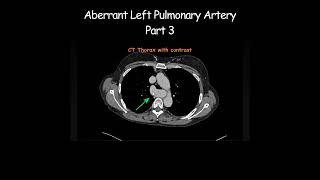 Aberrant Left Pulmonary Artery Part 3 radiology radiologist anatomy [upl. by Saxet335]