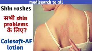 CalosoftAF lotionUsesसभी skin problems के लिएCommon skin rashes How to apply in hindi [upl. by Cuyler307]