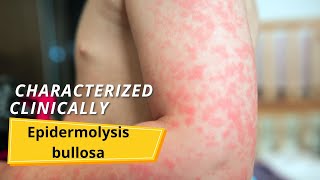 Epidermolysis bullosa  Symptoms and causes [upl. by Merat]