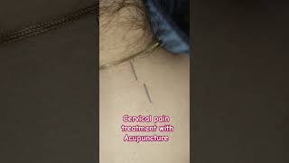 Acupuncture treatment for cervical spine acupuncturists painrelief [upl. by Enihpets939]