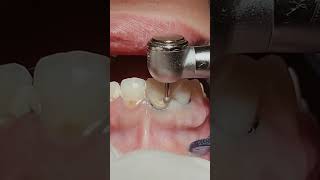 Loose gums and tooth decay repair the dentist Fill the🦷beadrepaircheapsavemoneyfillfixtooth [upl. by Flannery422]