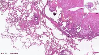 Pulmonary Hamartoma  Histopathology [upl. by Sirotek]