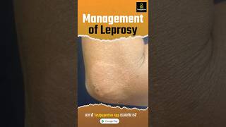 Management of Leprosy  Treatment Prevention Leprosy management treatment shortvideo nursing [upl. by Adnarahs227]