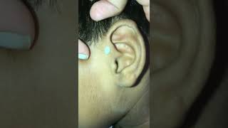 Squeezing preauricular pit earpit satisfying pimplepopping [upl. by Arac]