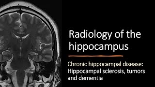 Radiology of the hippocampus  chronic hippocampal disease [upl. by Susi]