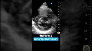 Learn parasternal short axis view [upl. by Fenelia]