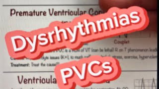 Dysrhythmias PVCs [upl. by Beilul327]