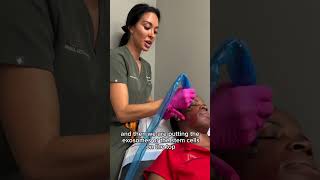 My microneedling treatment  Microneedling is percutaneous collagen induction [upl. by Ellenaj]