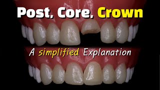 Fixing a broken front tooth with a post core buildup and crown after a root canal [upl. by Aliuqaj]