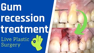 Gum recession surgery  Live Treatment Rotated Pedicle Flap [upl. by Recneps]