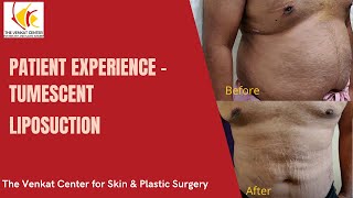 Patient Experience  Tumescent Liposuction at Venkat Center [upl. by Airtemad]