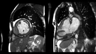 Acute Myocardial Infarction Caused By External Coronary Artery Compression [upl. by Efthim732]