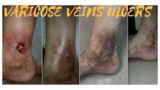 Best Treatments for Varicose veins symptoms causes life style treatment options prevention [upl. by Anaiq986]