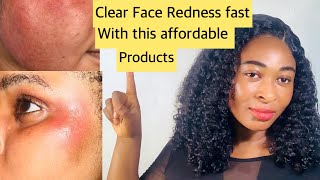 Get rid of face redness fast with this cheap products within 2weeks  clear face redness quickly 💯 [upl. by Vinni]