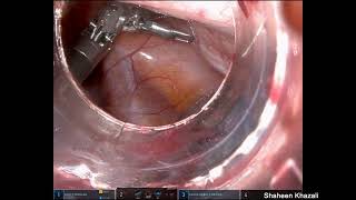 Robotic Assisted Excision of Accessory Cavitated Uterine Malformation [upl. by Niamreg632]