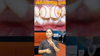 சேலம் fluorosis  bleaching பற்களுக்கு செய்யலாமாshorts [upl. by Boulanger816]