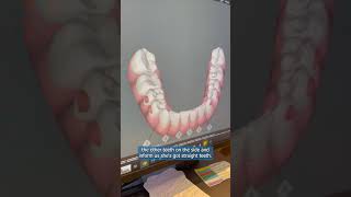 Part 2 Invisalign Clincheck [upl. by Quenby]