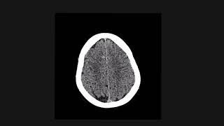 How to figure out nontraumatic causes of intracranial bleeding [upl. by Angell]