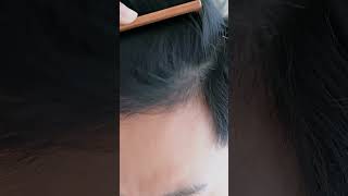 Does Saw Palmetto Help Hair Growth [upl. by Adrienne]