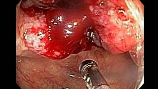 Endoscopy of Colon Cancer Cecum [upl. by Schluter]