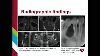 Adenomatoid Odontogenic Tumor AOT [upl. by Arahset]