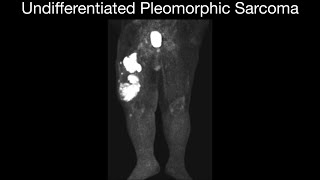 High Grade Undifferentiated Pleomorphic Sarcoma [upl. by Onateag376]