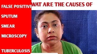 WAT ARE THE CAUSES OF FALSE POSITIVE SPUTUM SMEAR MICROSCOPY TUBERCULOSIS [upl. by Icats]