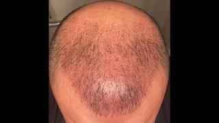 Hair transplant result in 10 Week’s 4200 graft Dr Serkan Aygın Clinic [upl. by Millan771]