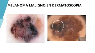 Principios y fundamentos de la dermatoscopia [upl. by Nagaek]